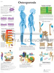 Osteoporosis - Anatomical Chart